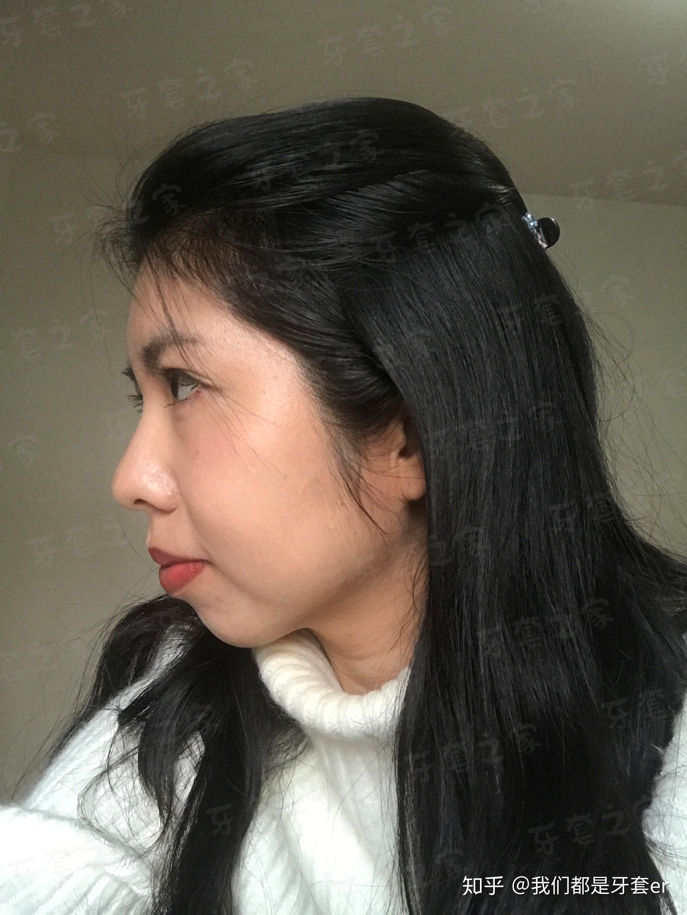 案例分享牙性骨性龅牙嘴突下巴后缩没打骨钉但效果很满意还成功安利了