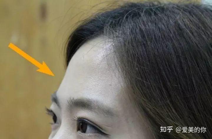 有抬头纹位于额头发际线至眉毛之间的横向的皮肤褶皱,这类情况比较