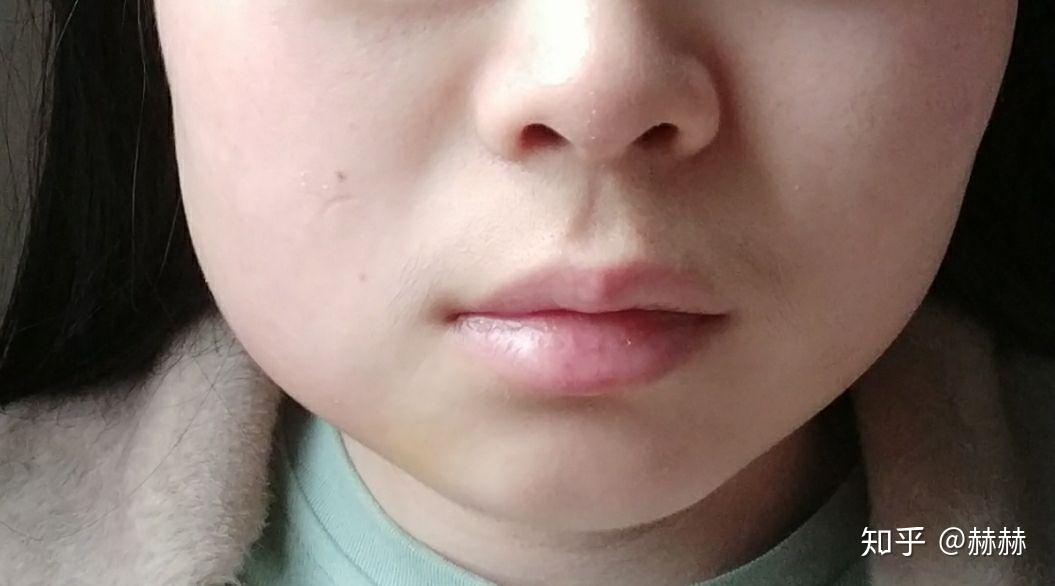 拔水平阻生智齿术后第二天脸肿了请问几天能消肿