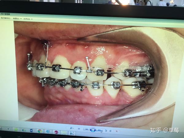 正畸内收一半出现牙周严重萎缩和骨开窗怎么办