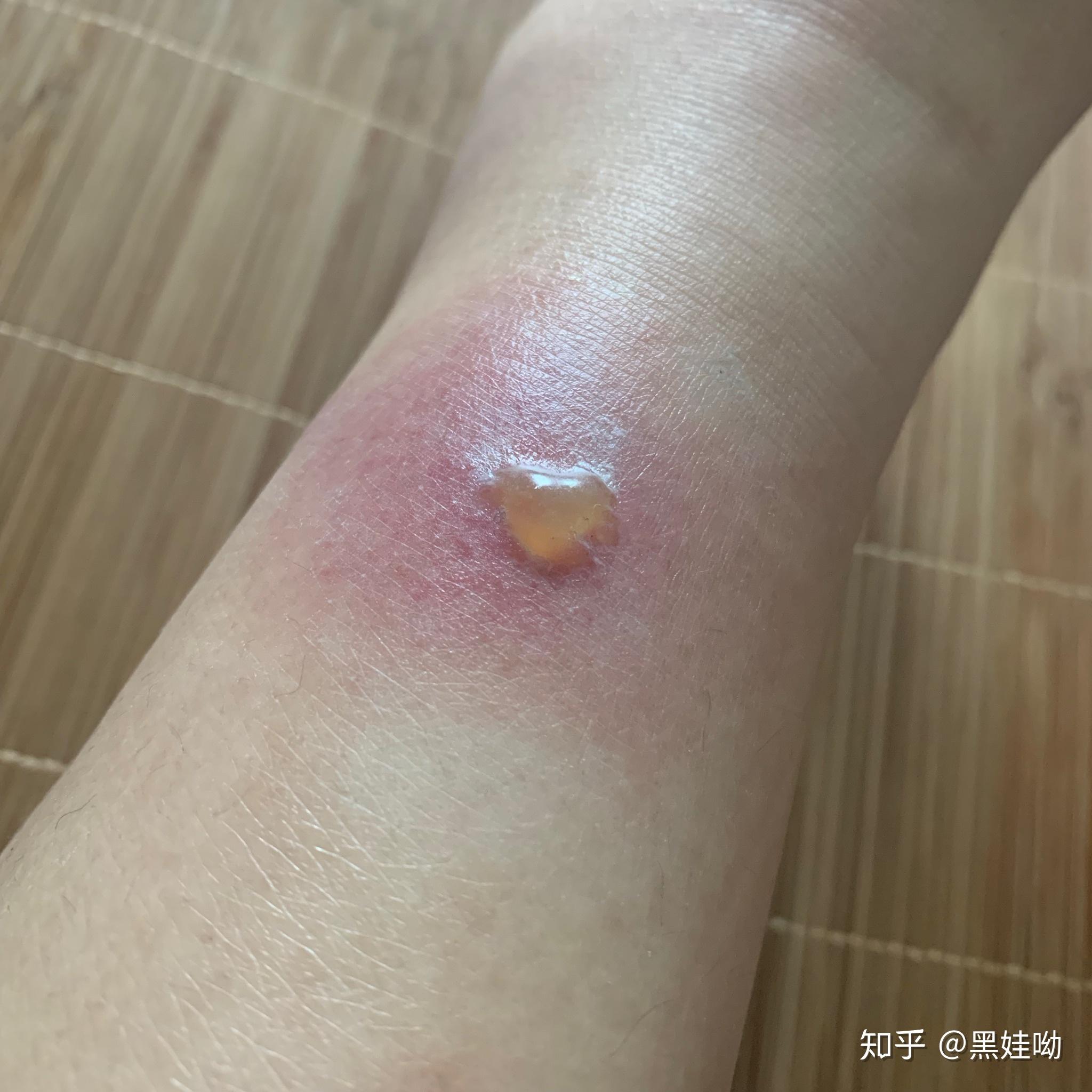 被蚊子咬的包第二天都肿的特别大怎办? - 知乎