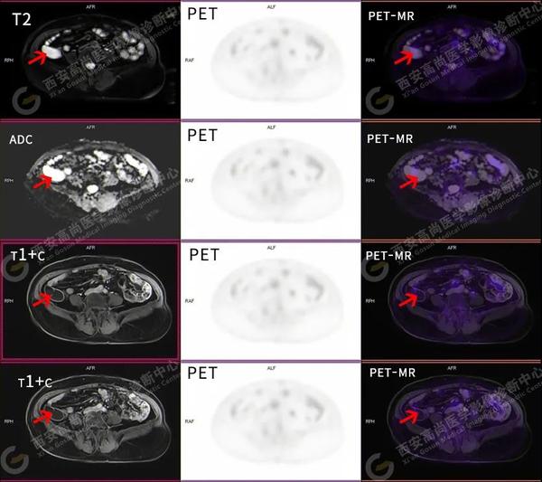  18f fdg petct mr 