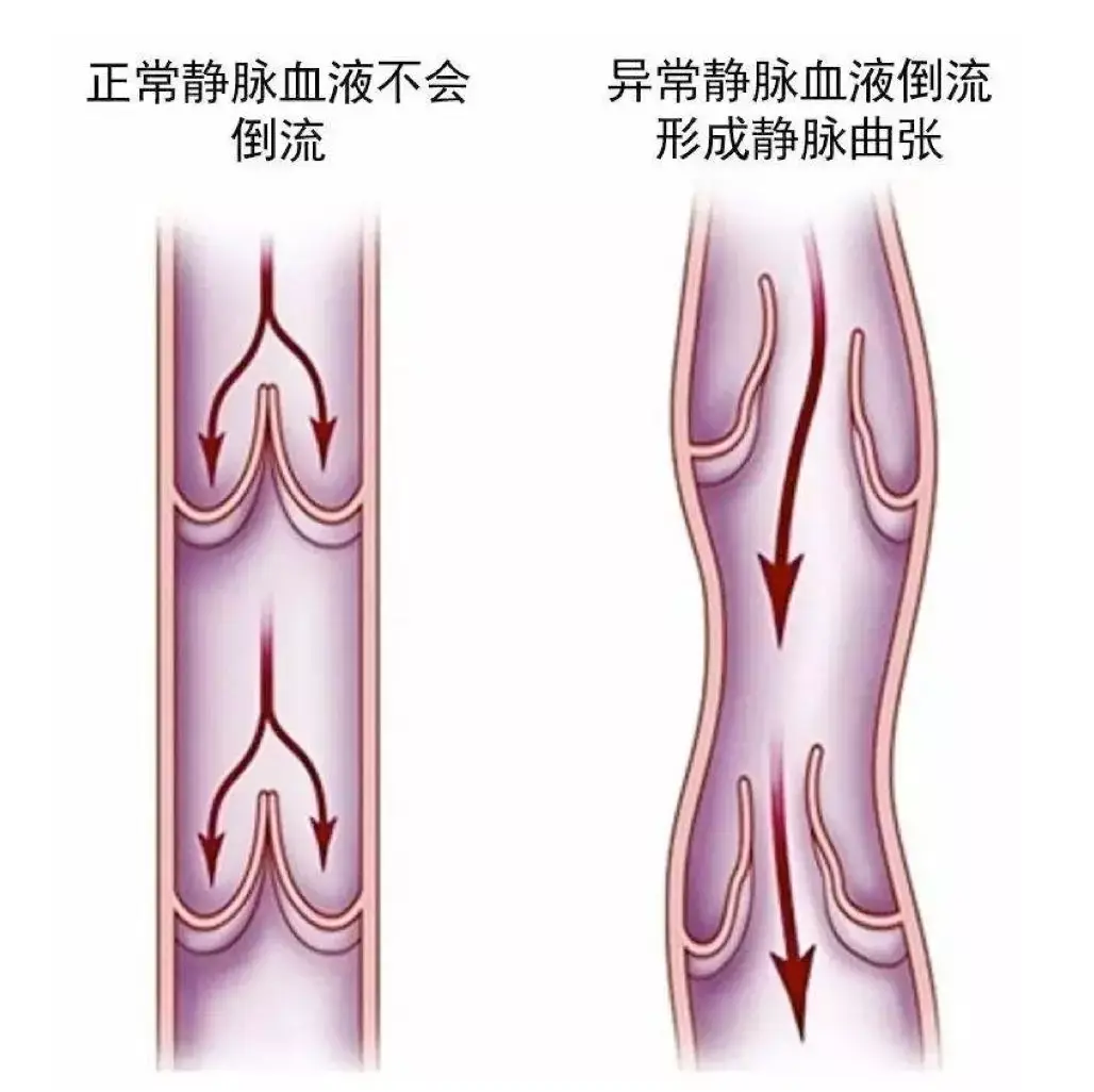 下腔静脉回流图片