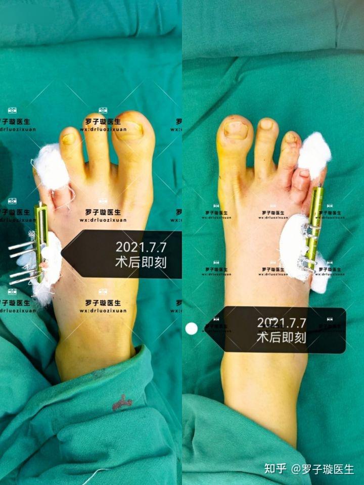 第四脚趾短小症—短趾症—治疗过程 