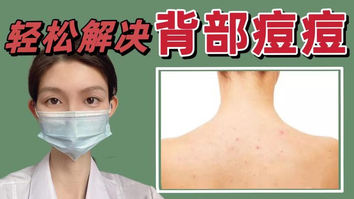 为什么背部长痘去看皮肤科,医生不建议你用背部祛痘的磨砂膏和沐浴露,而是推荐背部祛痘4部曲?是真有效还是花架子? - 知乎