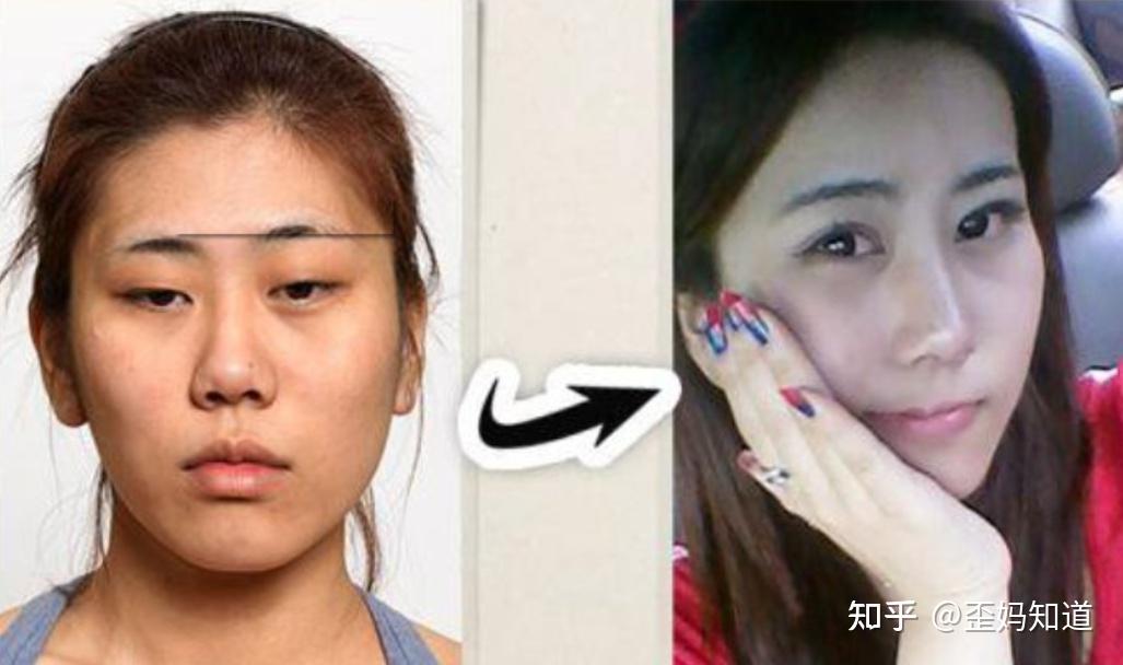 网红少女16岁开始整容,动刀200次花掉400万,如今只能坐轮椅 - 知乎