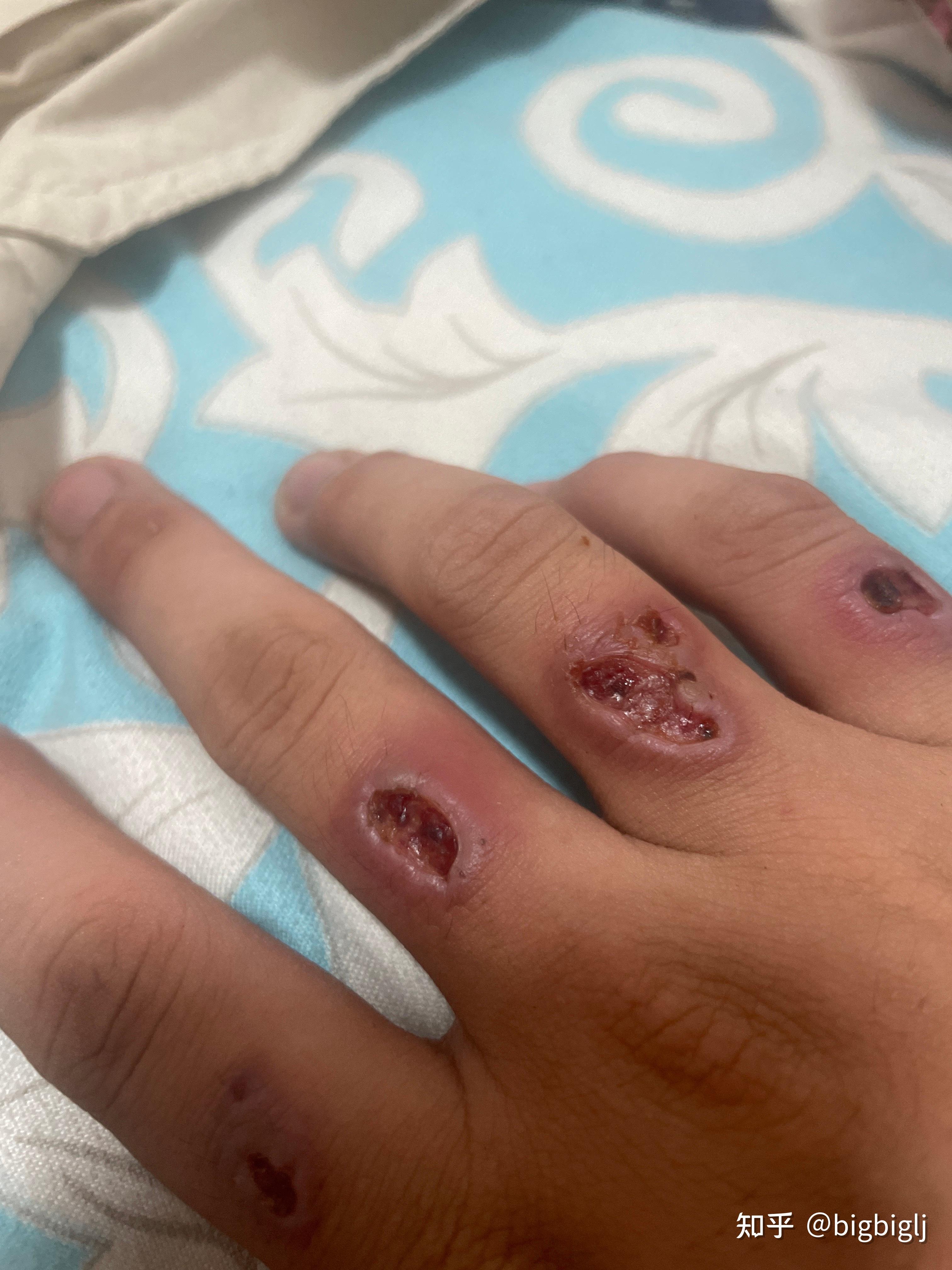 我洗纹身快一年了还没洗干净真的要分手吗? - 知乎