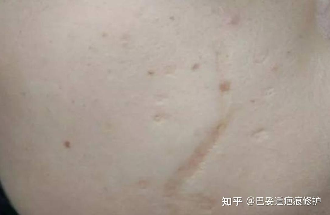 疤痕一般有哪几种分类? - 知乎