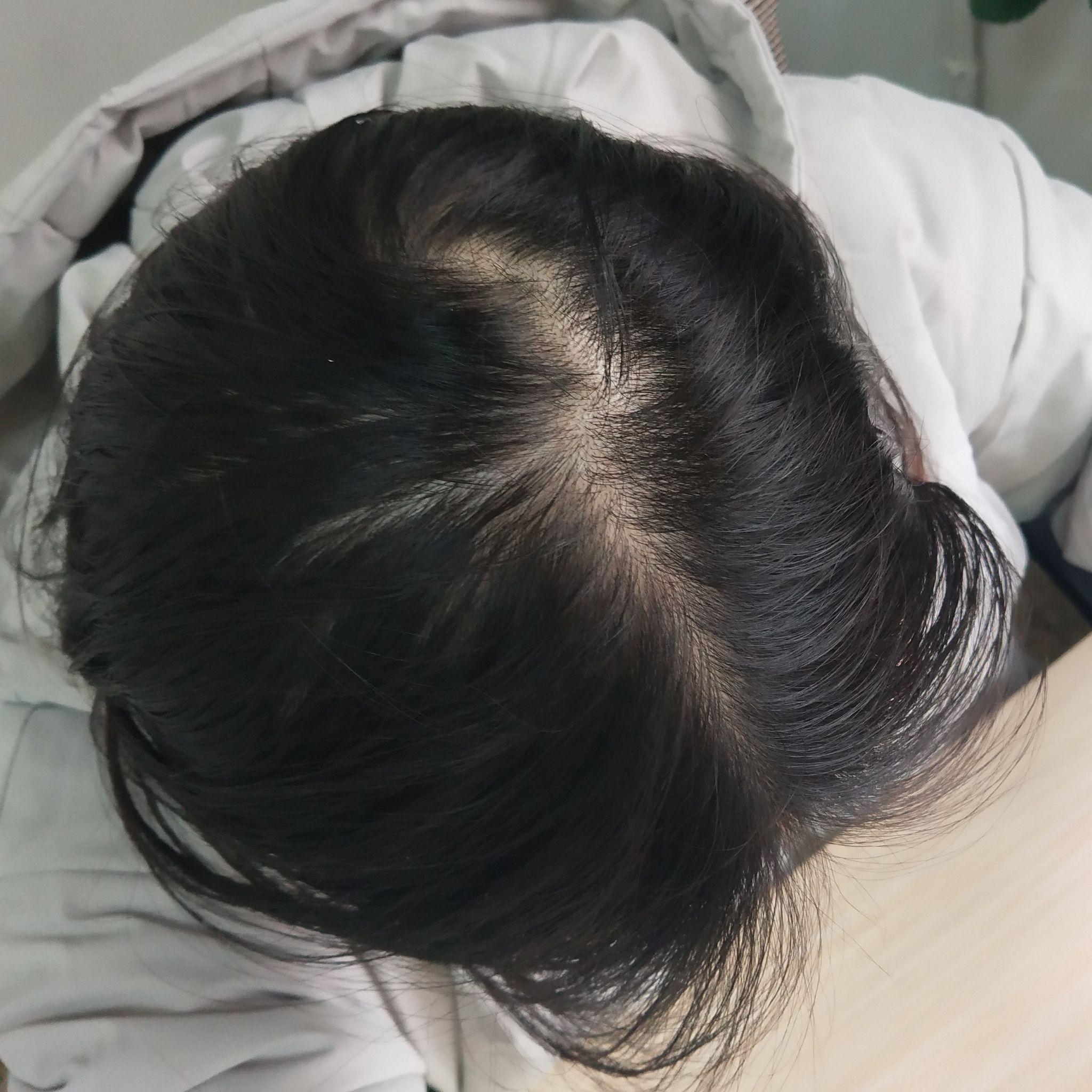 记录秃头少女自救计划