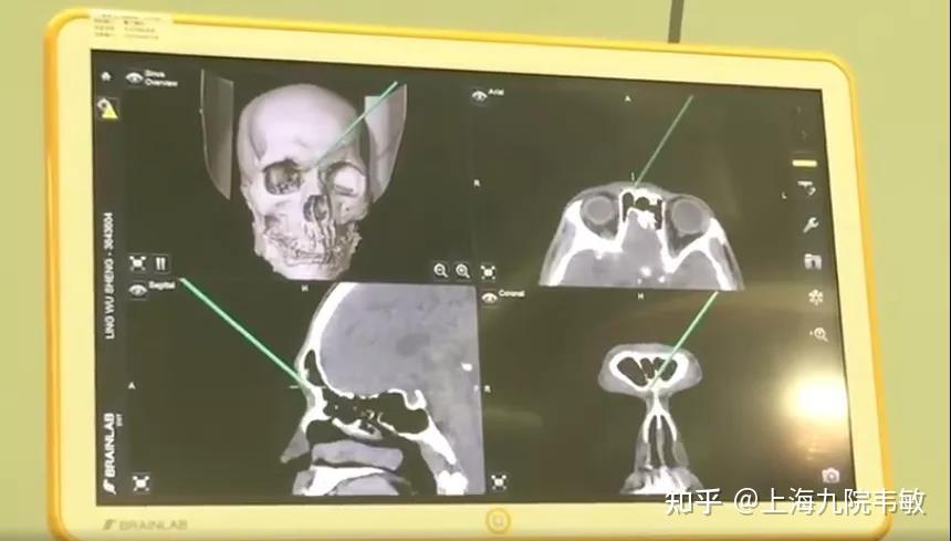 眉弓如何计算才算高,是越高越好吗 - 知乎