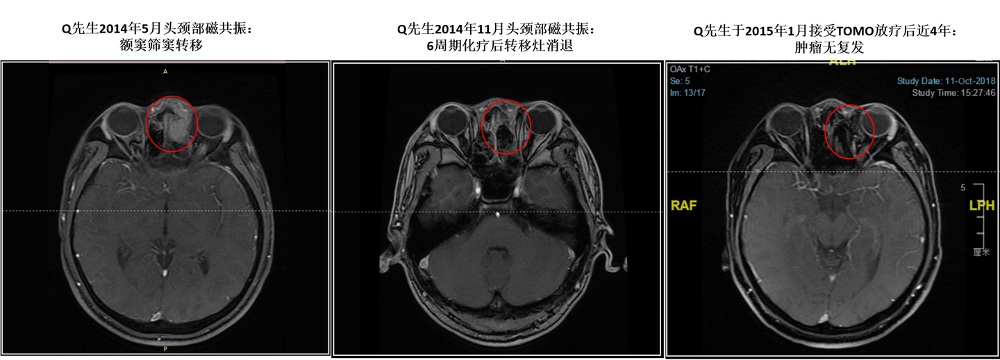 从21岁鼻咽癌复发患者赴日本再程放疗后已痊愈近4年 解析复发诊疗的挑战和希望 知乎