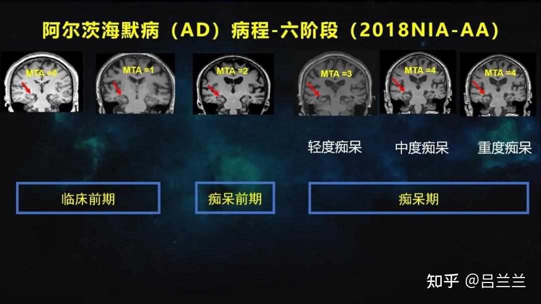 你认识“阿尔茨海默病”吗？ - 知乎