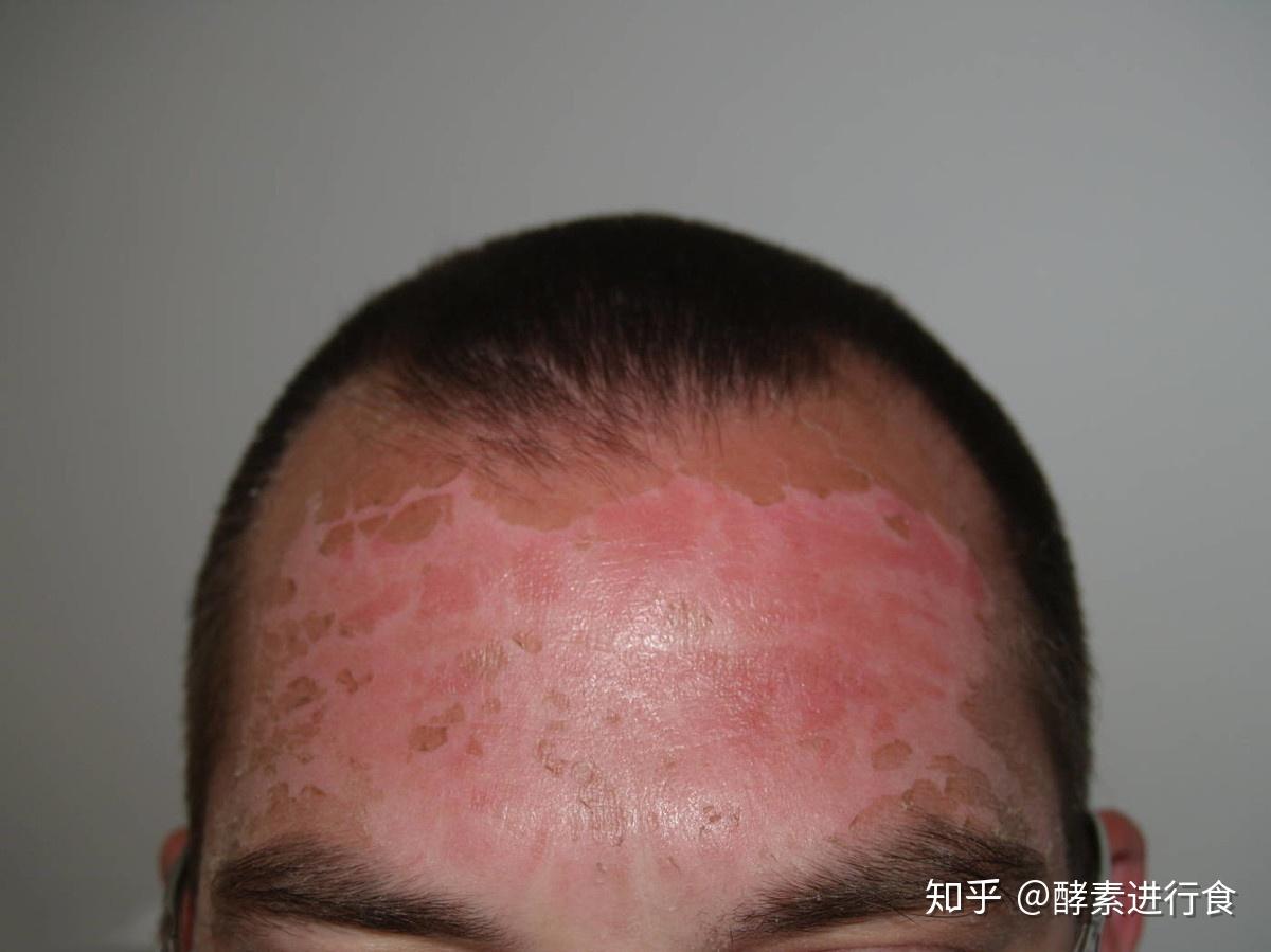 变态反应——过敏是如何导致的?你是否亲手将自己推向过敏体质? - 知乎
