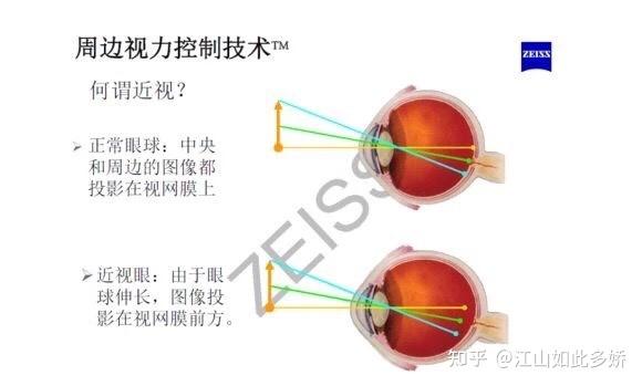 原理介绍:环焦,全焦和离焦这3种镜片有什么区别?