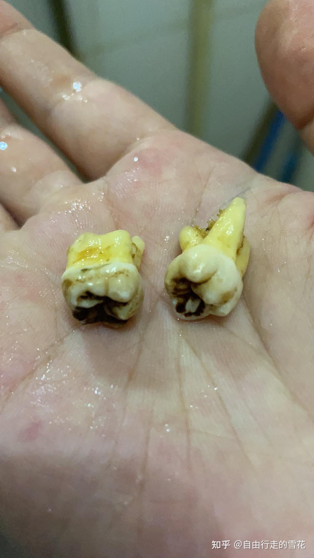 还有比我拔完牙更大的洞吗?