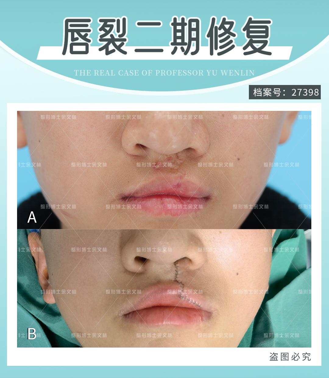 【案例分析】他唇鼻畸形明显,却只想改善疤痕问题,手术效果如何? - 知乎