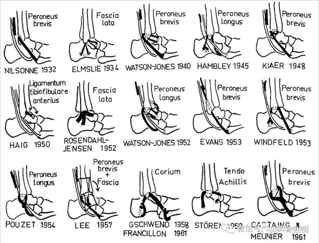 peroneus longus图片