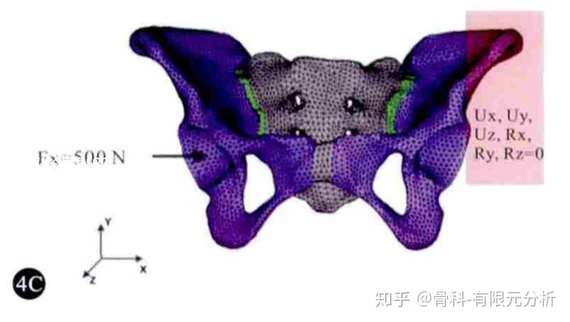 良好的骨盆加載和可靠的骨盆穩定性十分重要,選擇邊界條件和載荷定位