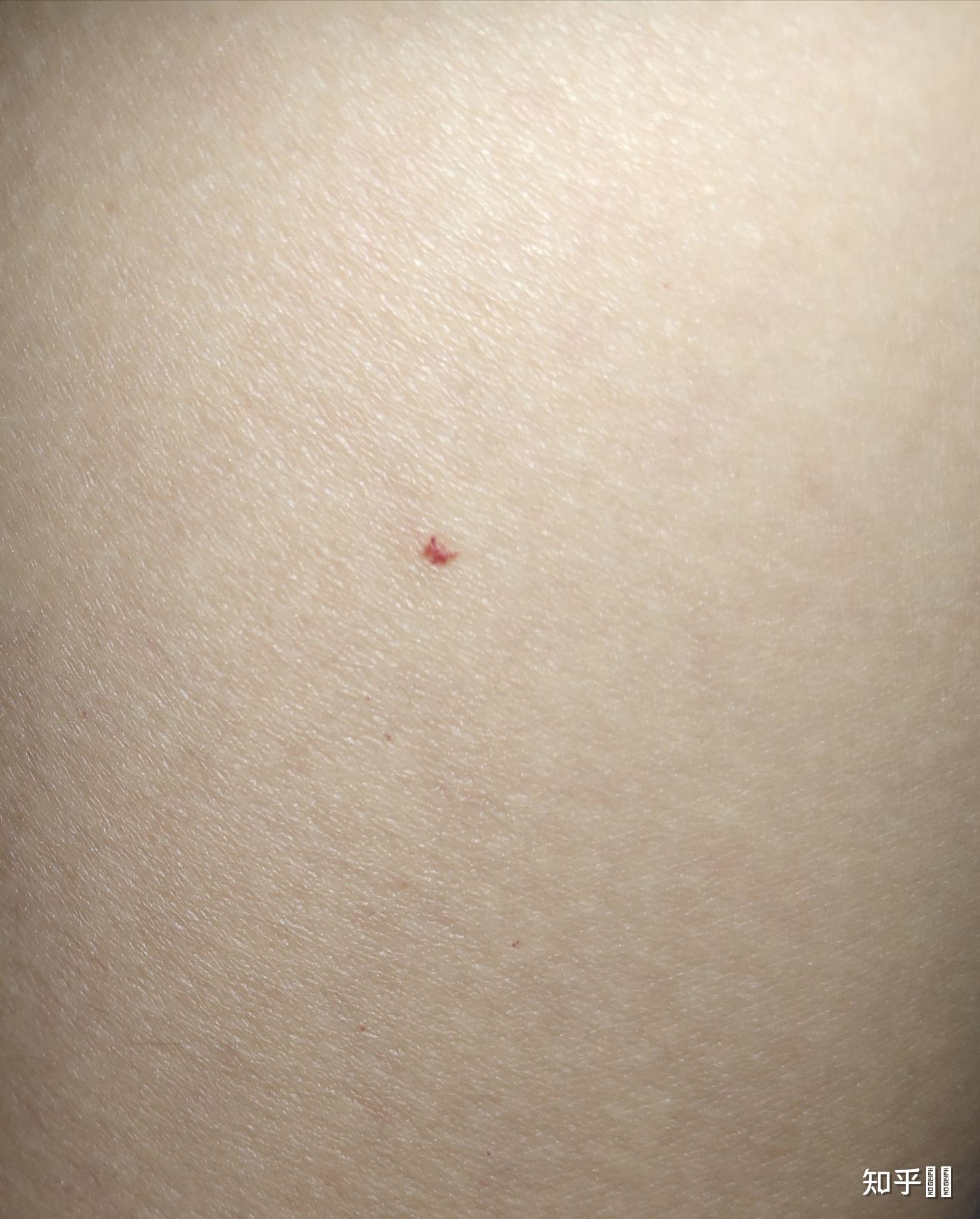最近很火的朱砂痣长什么样? - 知乎