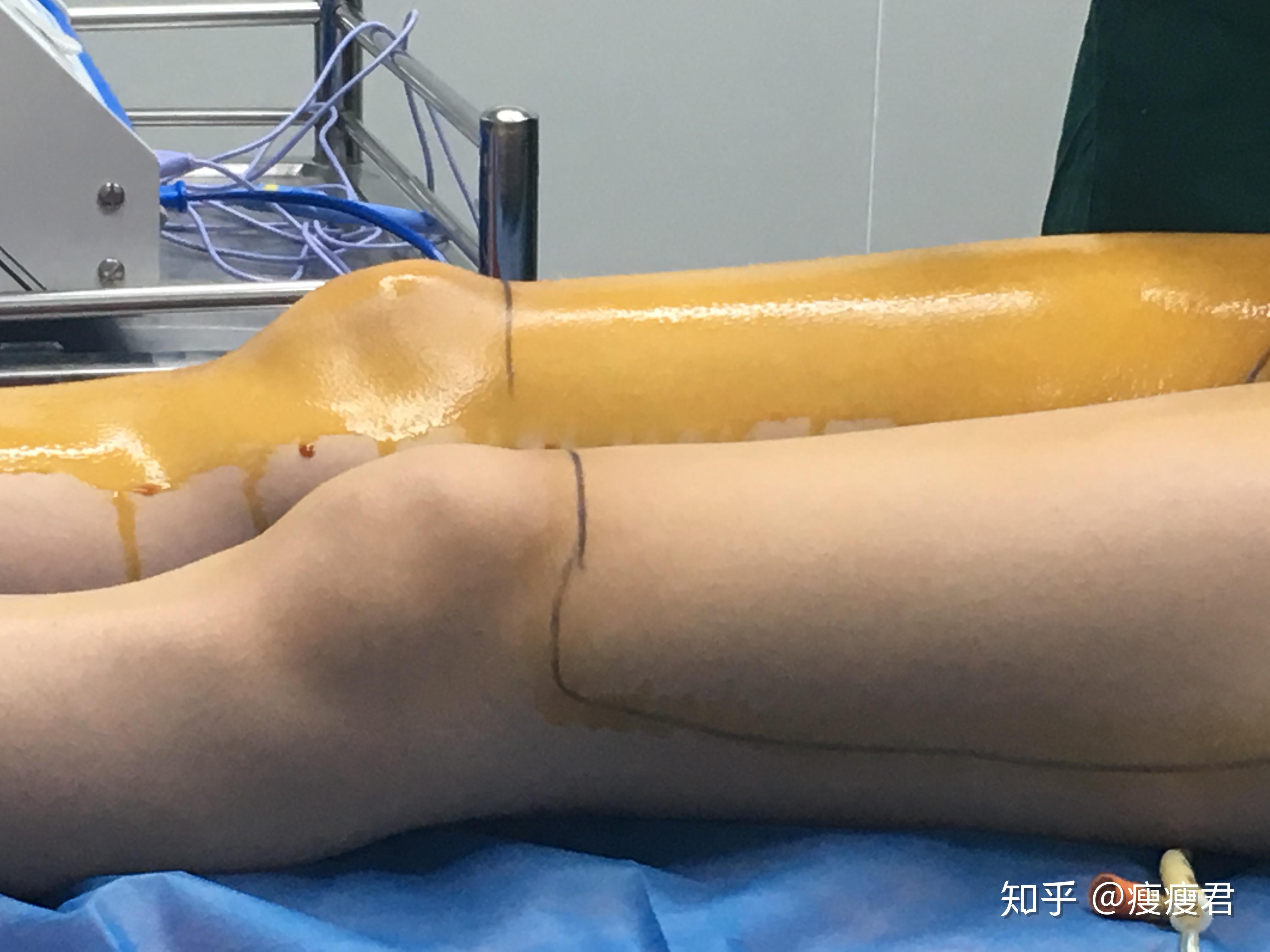 案例分享上海大腿吸脂手术后恢复三个月