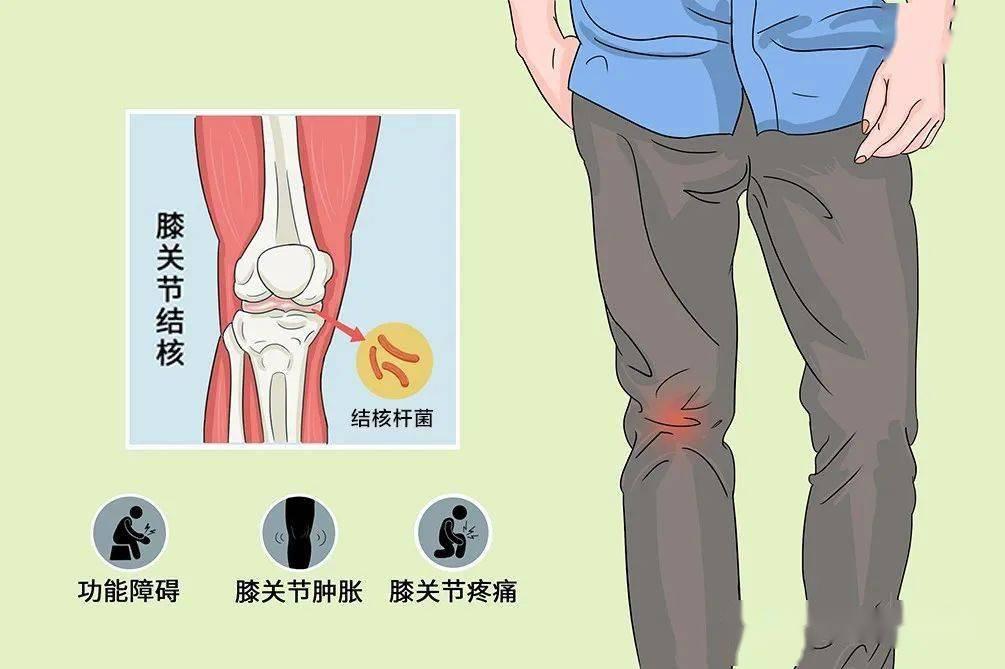 膝关节结核的症状体征是什么样的?