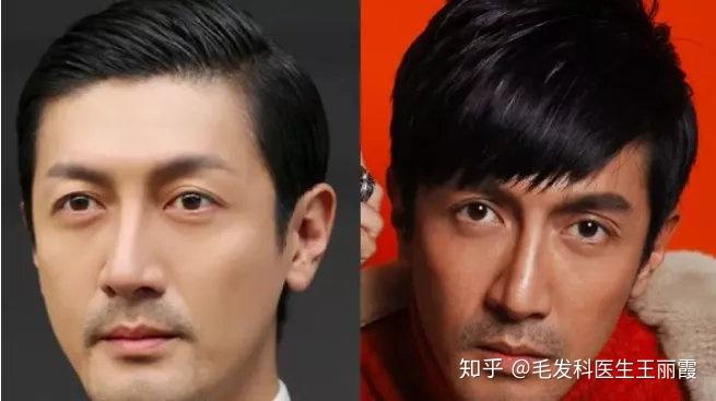 中庭长就是最明显的长脸,这种情况下可以通过刘海修饰,或者通过调整