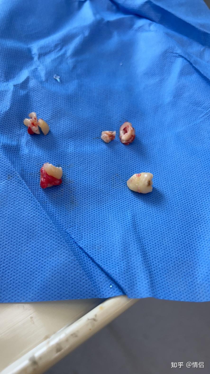 一次性拔完4颗智齿感觉超爽