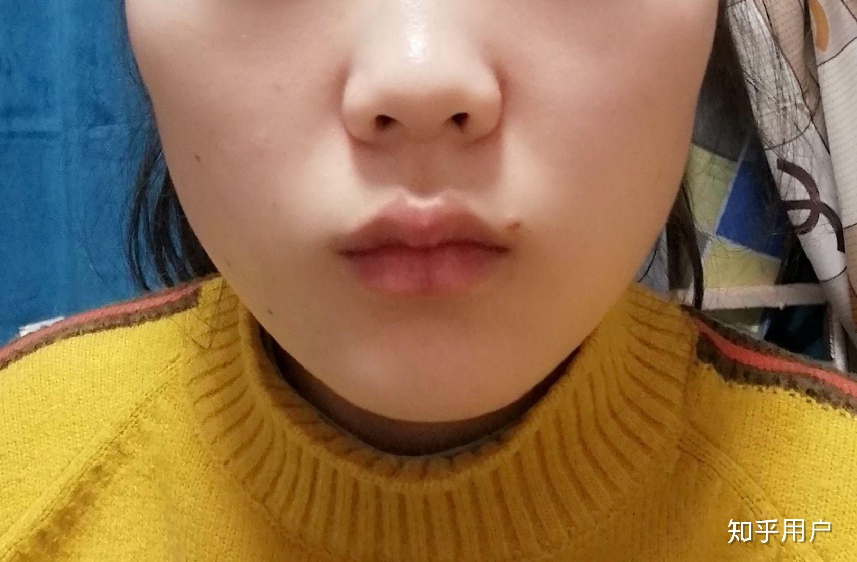 上嘴唇上翘,上翻怎么办?侧面看起来简直丑哭我! - 知乎
