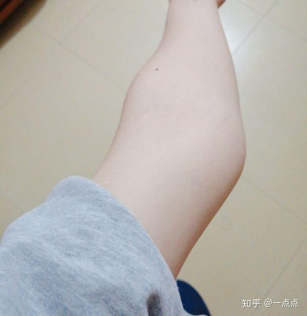 肘外翻是一种怎样的体验 如图? - 知乎