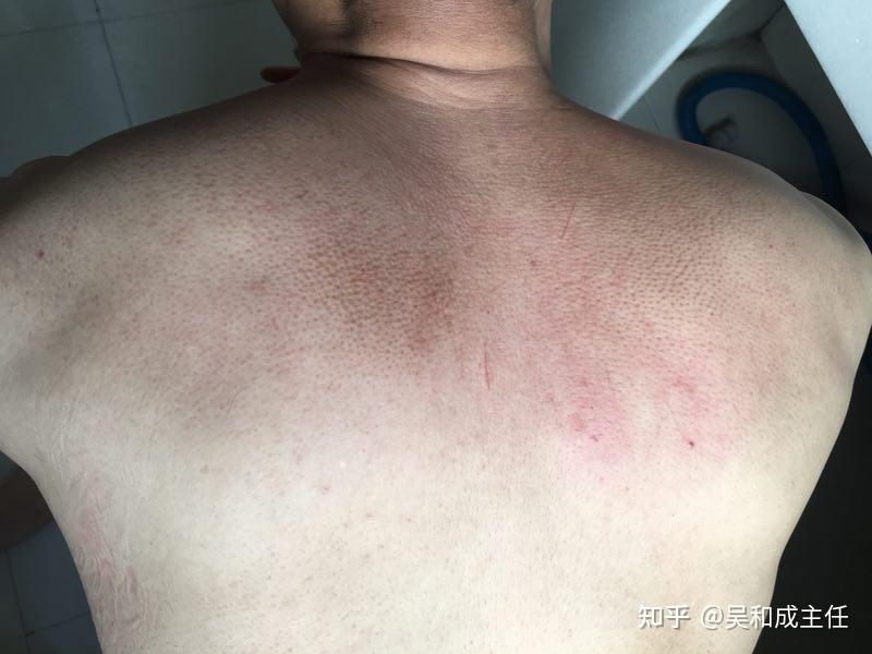 黑棘皮病如何治疗？ - 知乎