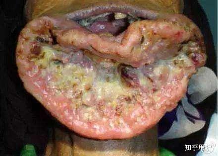 槟榔吃烂嘴的严重图片图片