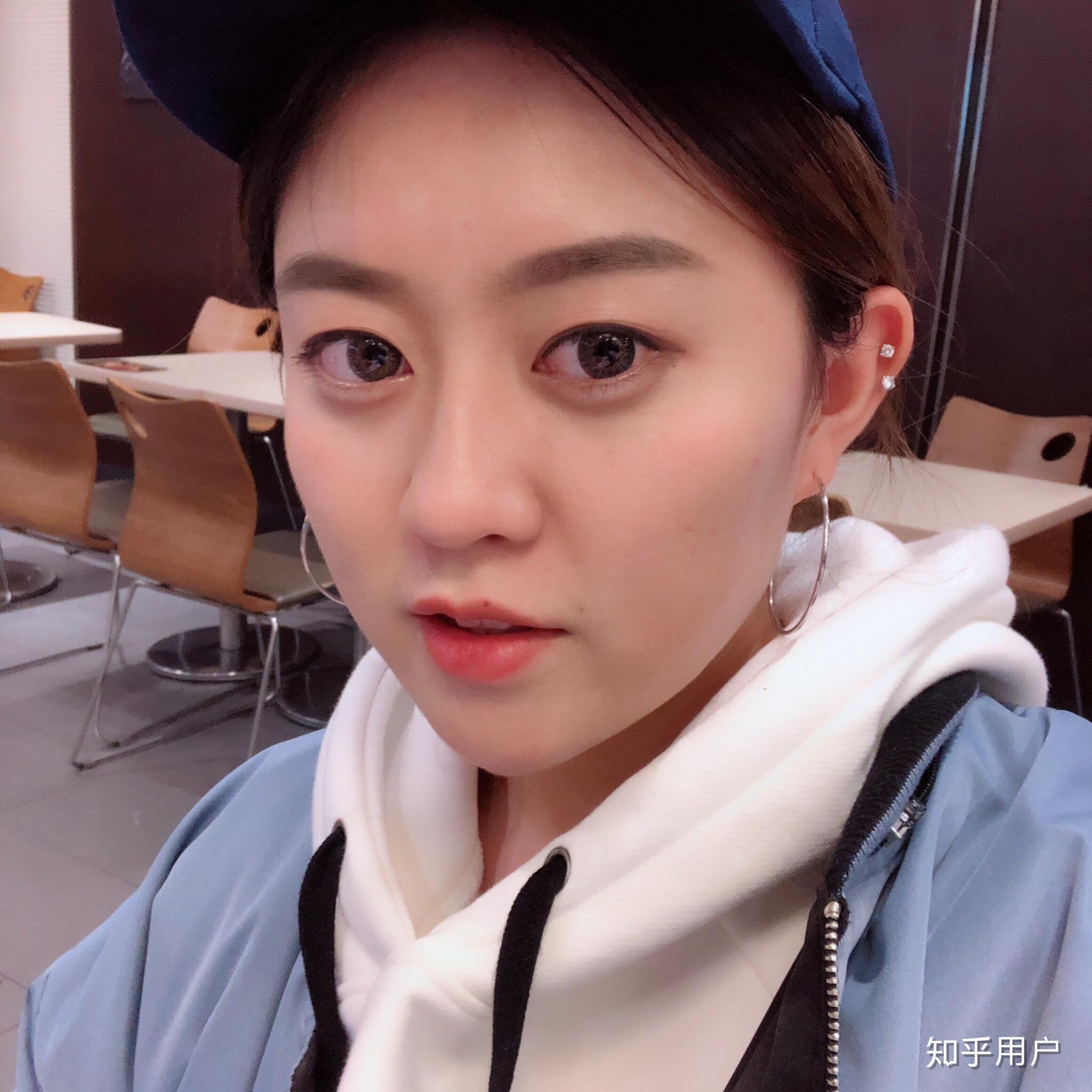 吊眼又是单眼皮不整容怎么改善