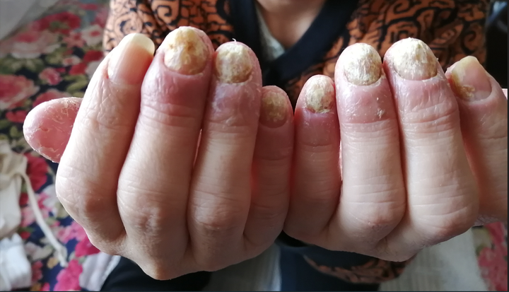 掌跖脓疱病指甲变形,已经有四年了,很痛苦