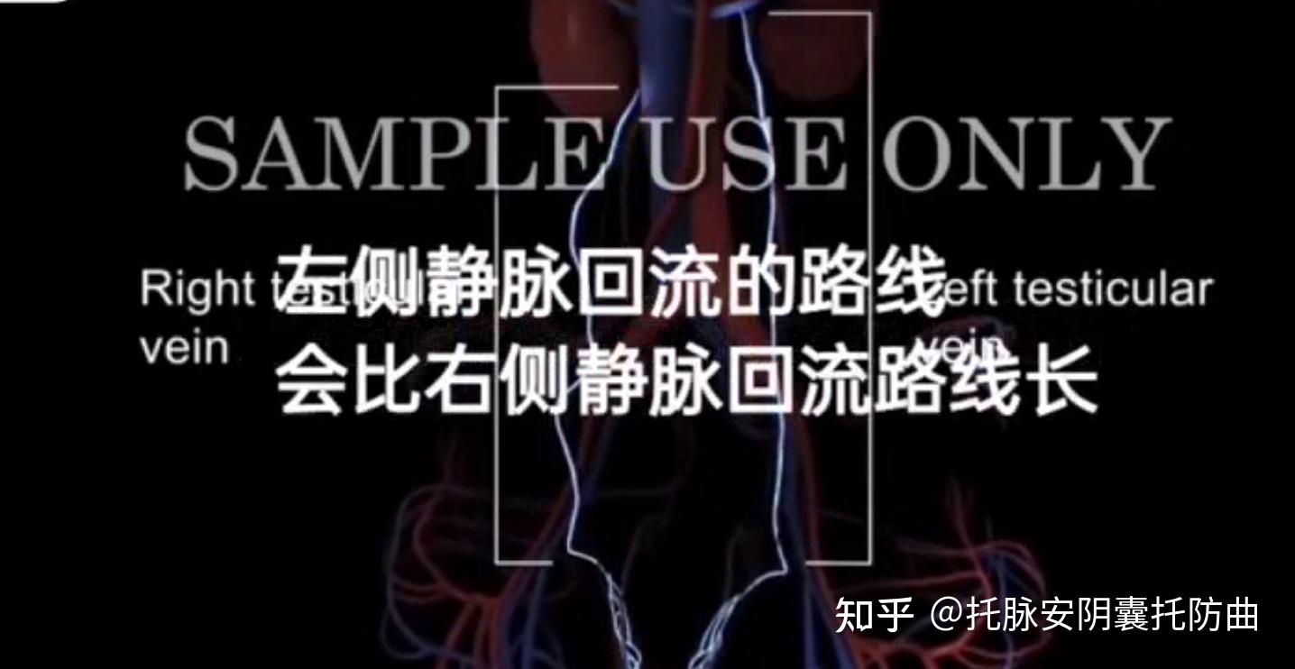 双侧精索静脉曲张怎么引起的? - 知乎