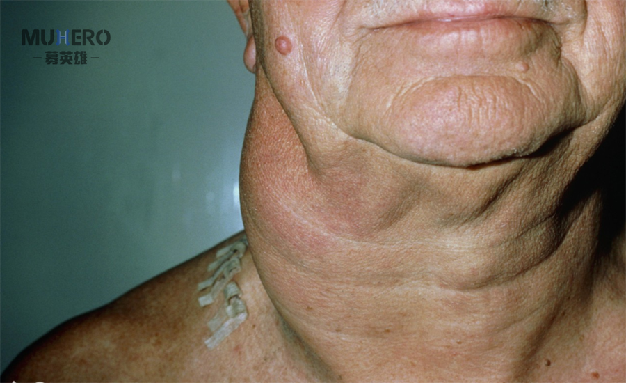 你对恶性淋巴瘤了解多少