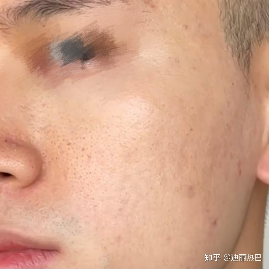 男生毛孔粗大,皮膚很黑很粗糙,怎麼辦?