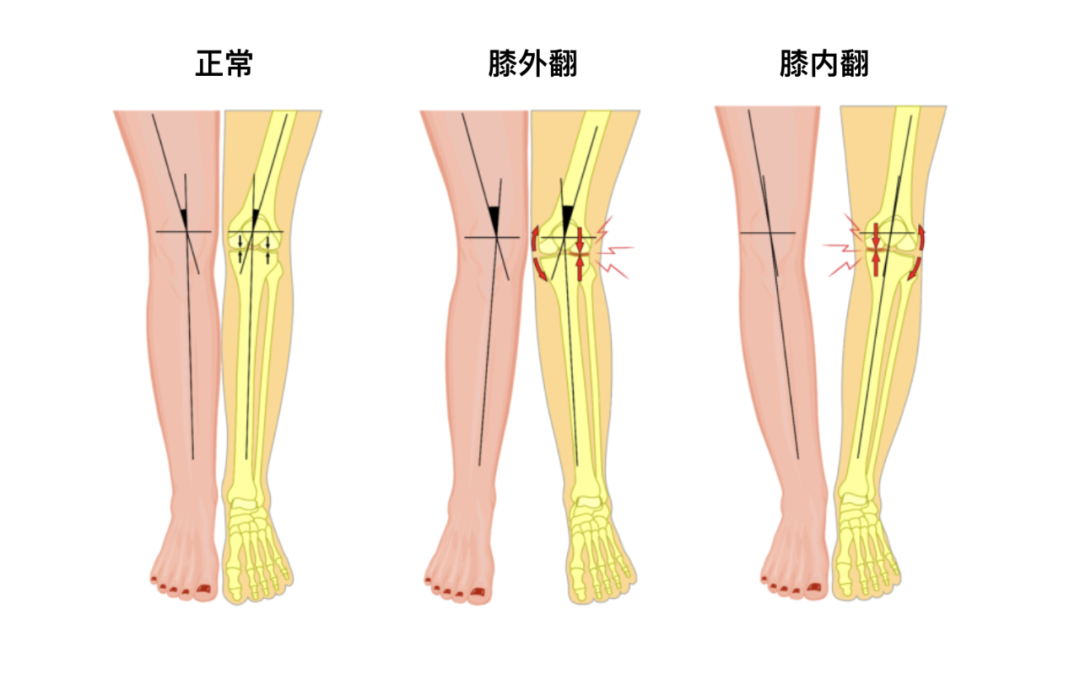 膝内外翻是如何形成的这些情况会使得股骨和胫骨之间的夹角发生变化