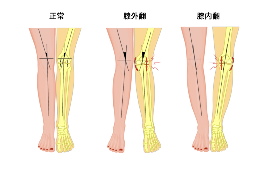 股骨内髁间距离图片图片