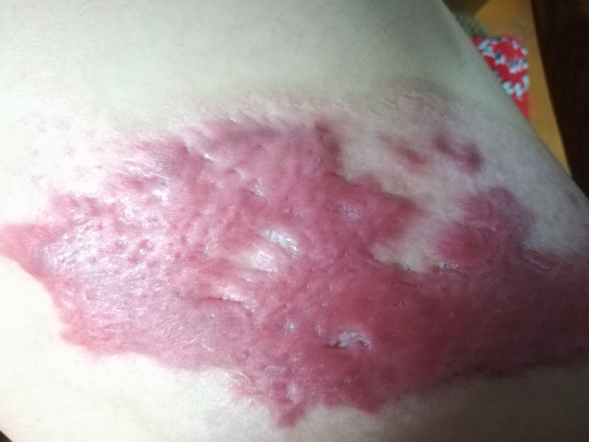 深二度烫伤完全恢复后会留下什么程度的疤痕? - 知乎