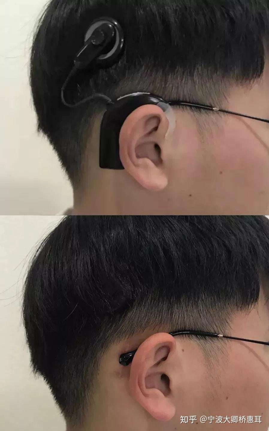 让人工耳蜗隐形的体外机kanso