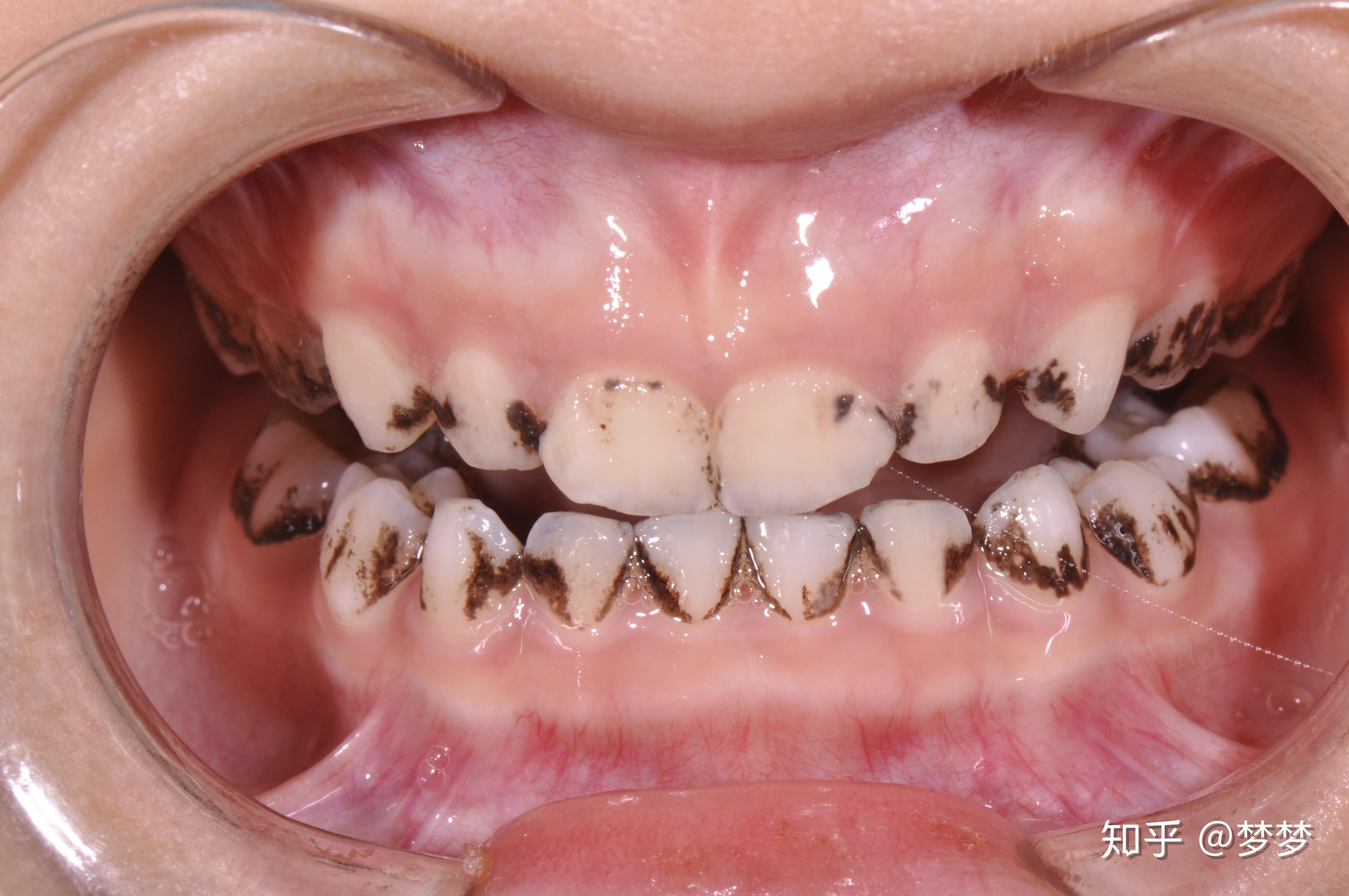 三岁宝宝的牙齿黑怎么办? - 知乎