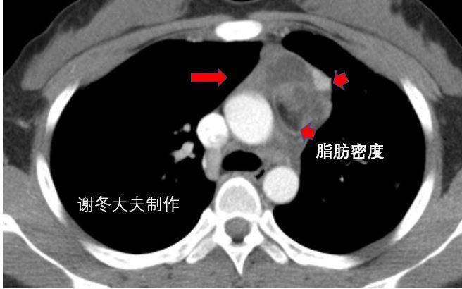 增強ct是否能判斷胸腺瘤是良性還是惡性的