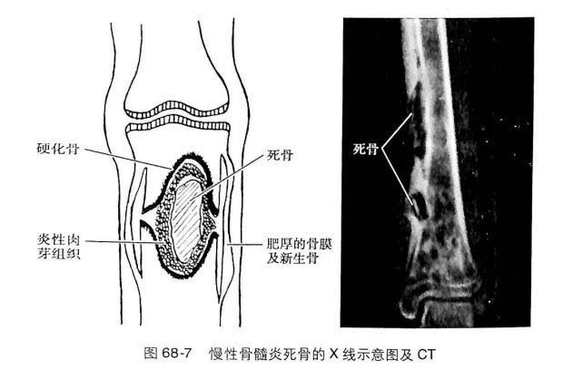 ⑵ct——显示脓腔与小型死骨.