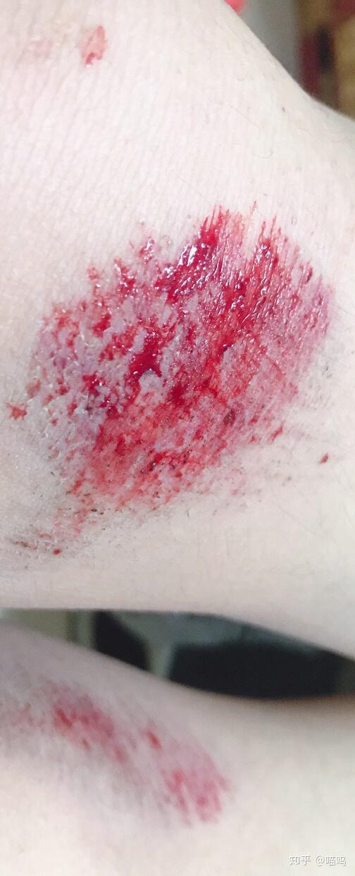 膝盖摔伤,抹了碘伏结痂后如何防止留疤? - 知乎