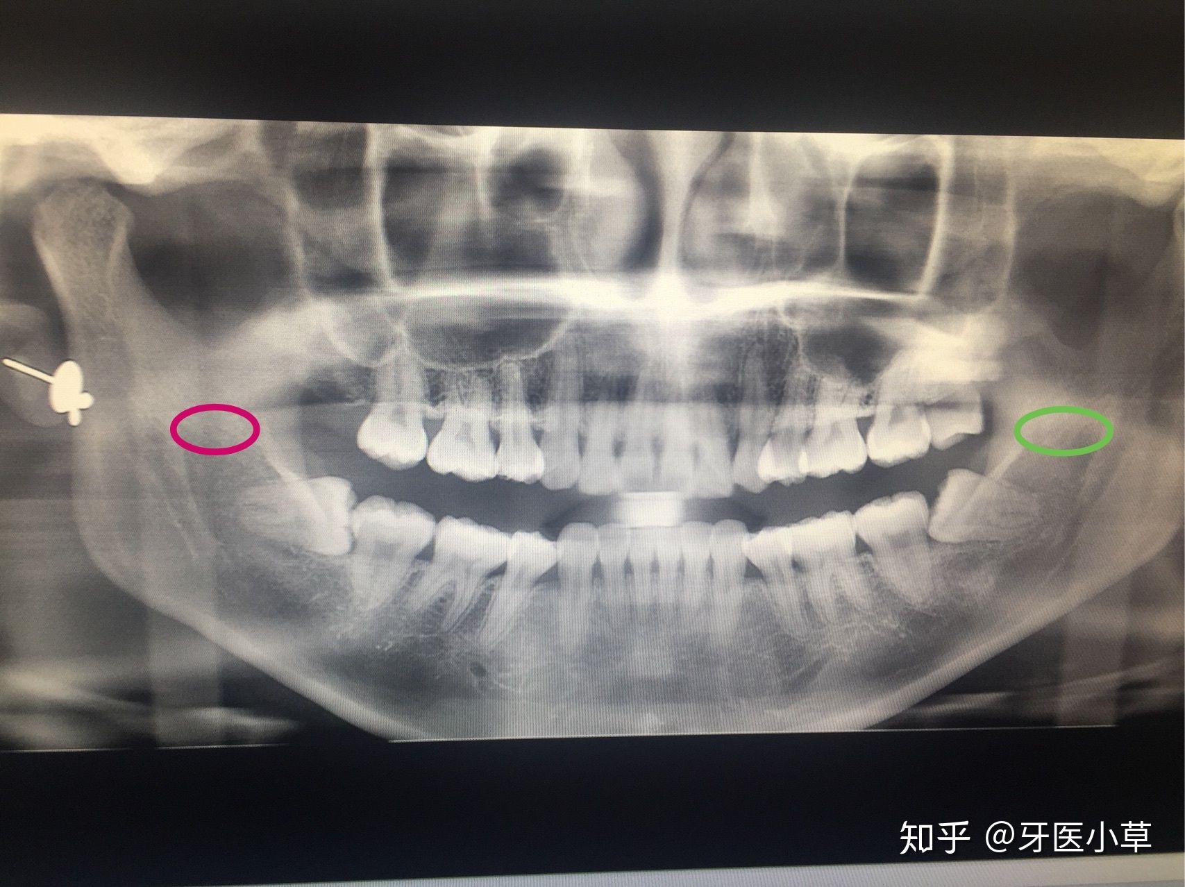 口腔x光片怎么分左右? - 知乎