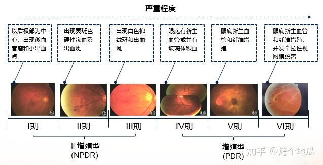 糖尿病视网膜病变 激光治疗? - 知乎
