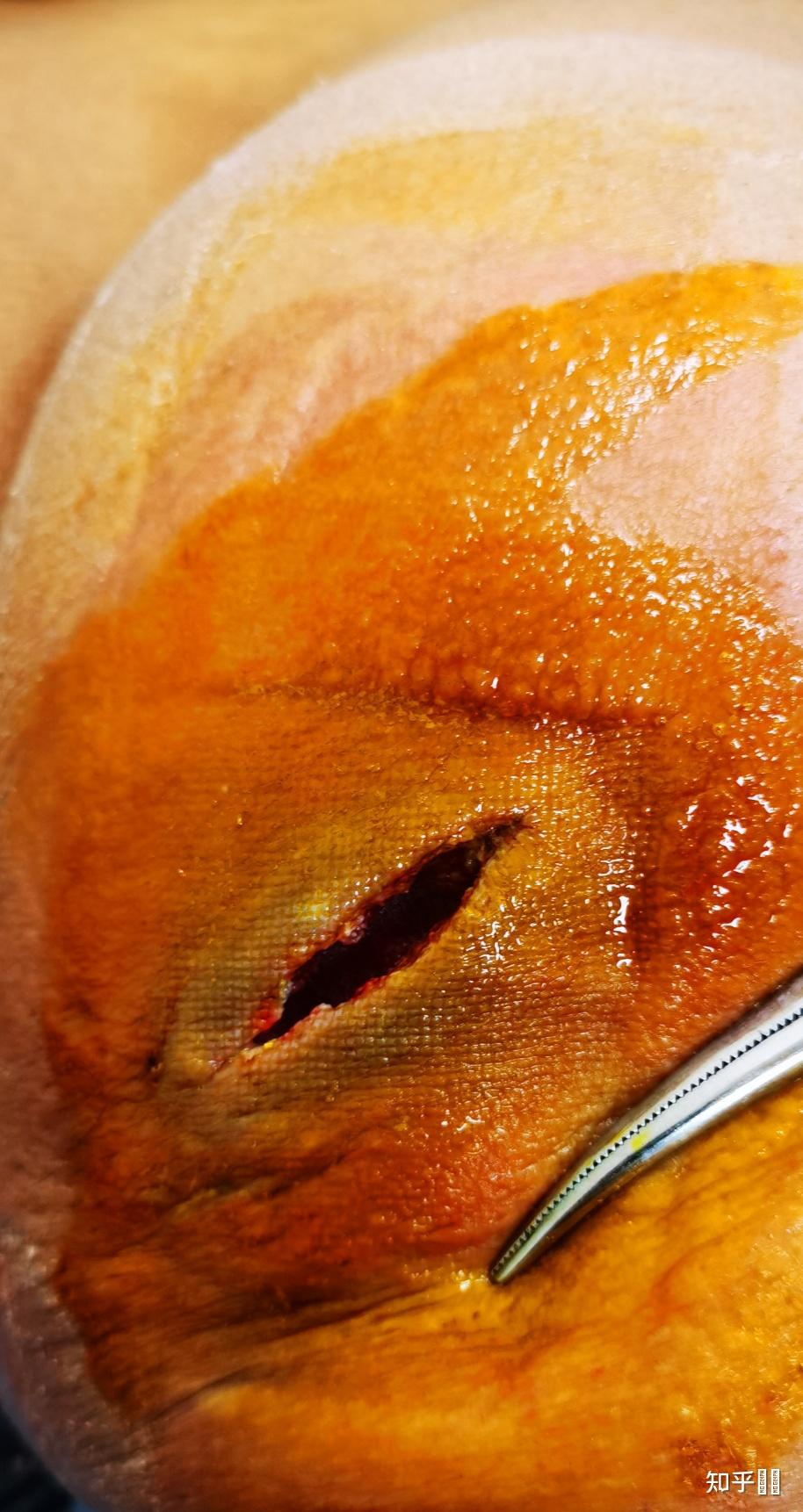 臀部有个硬块 皮脂腺囊肿 可以不手术治疗吗?