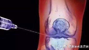 到底什么叫髌骨软化 v2-82a82bf995bd5240ded04d08b94c9c3d_1440w.jpg?source=172ae18b