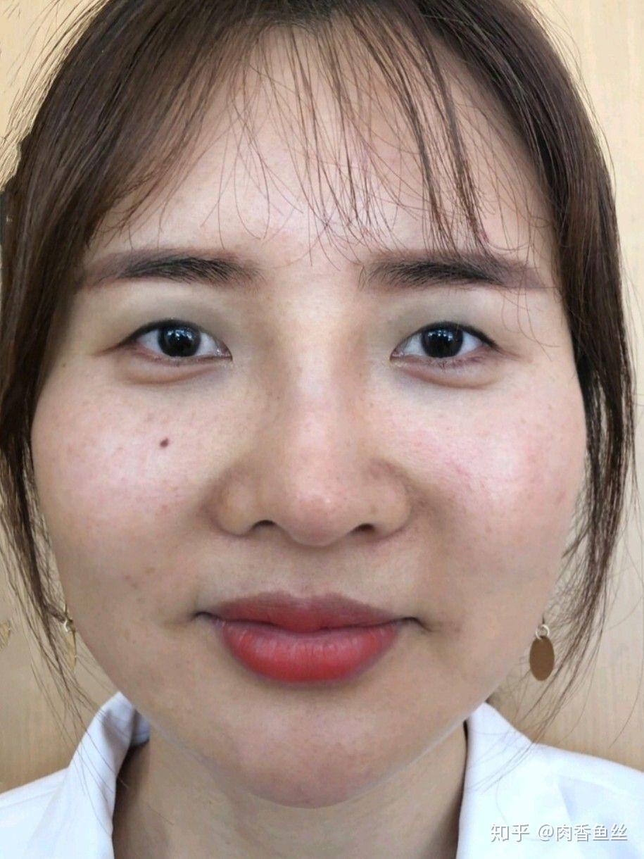 肉鼻子有什么解决的办法