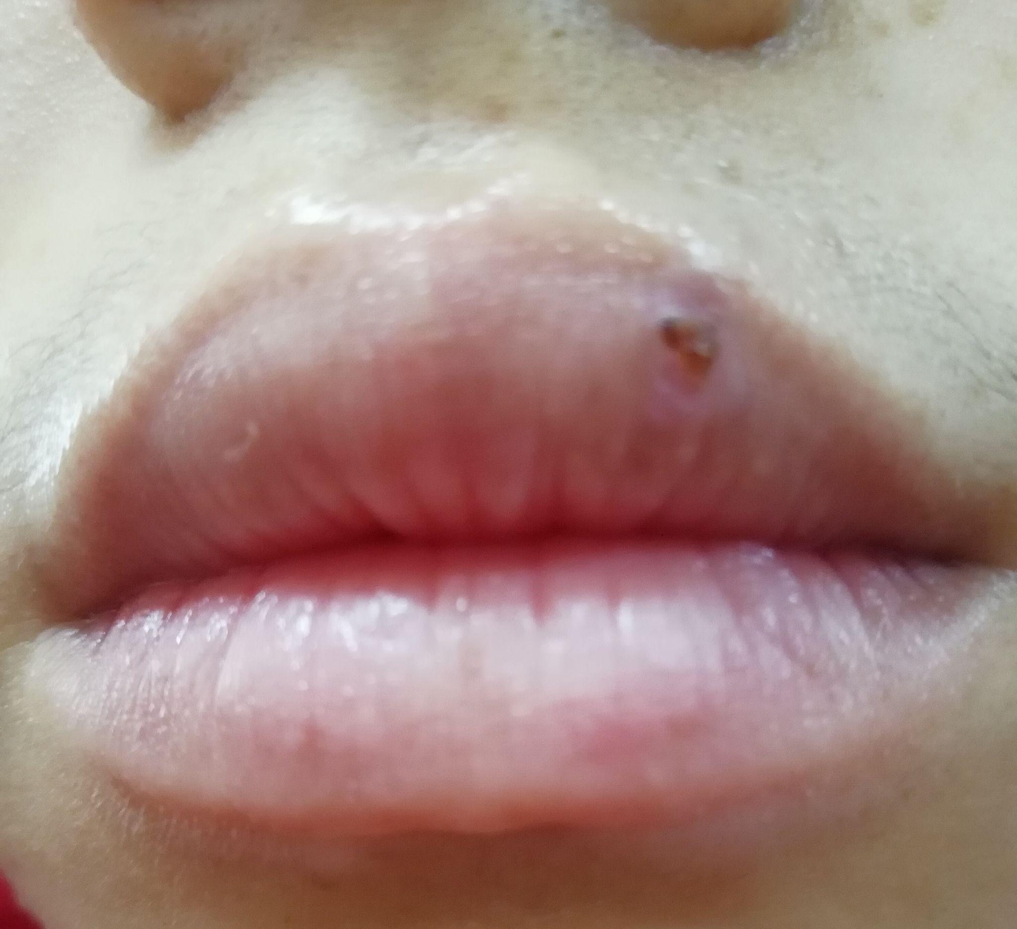 嘴唇上最近长了几个黑点像痣又像斑怎么能去除